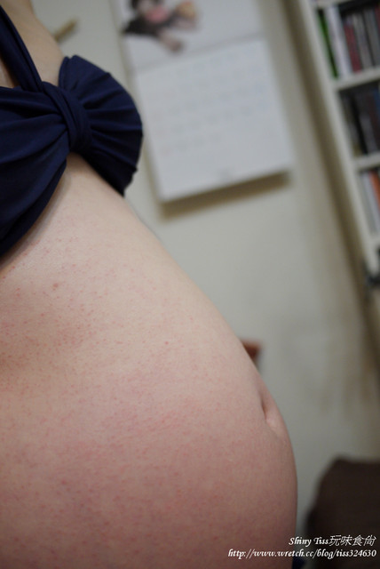 妊娠癢疹,懷孕五個月,癢疹症狀,癢疹原因,癢疹,癢疹治療