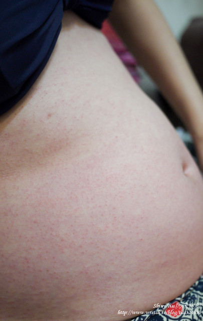 妊娠癢疹,懷孕五個月,癢疹症狀,癢疹原因,癢疹,癢疹治療